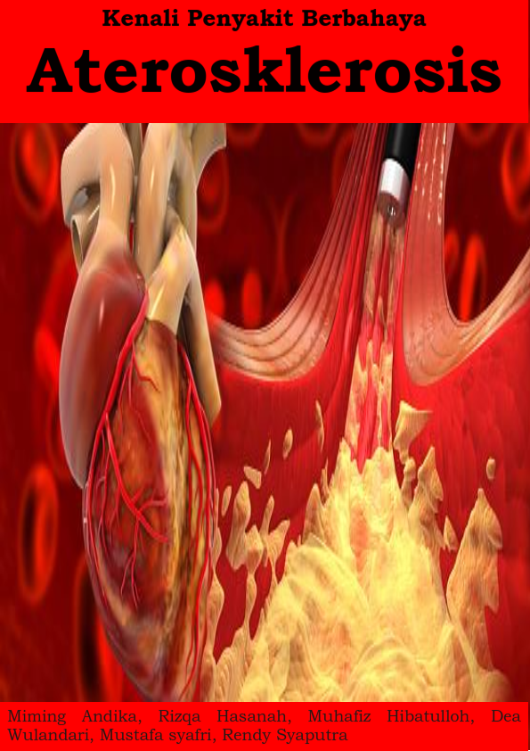 Kenali Penyakit Berbahaya aterosklerosis
